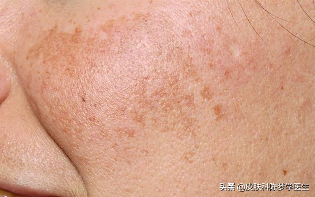 4个治疗面部色斑的方法,25岁脸部色斑怎么治