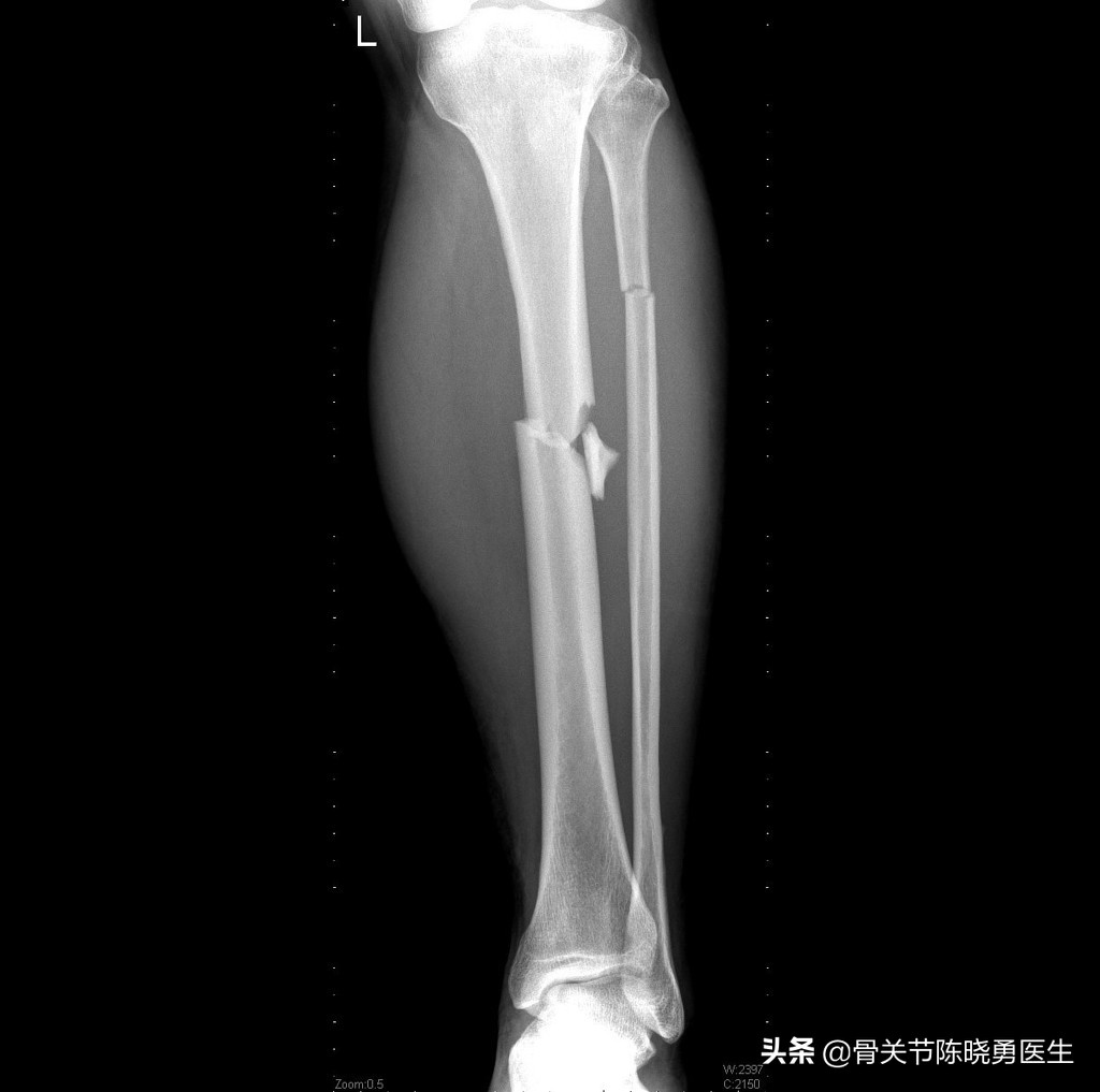 小孩胫骨和腓骨骨折未手术疼多久,14岁腓骨骨折保守治疗还是手术