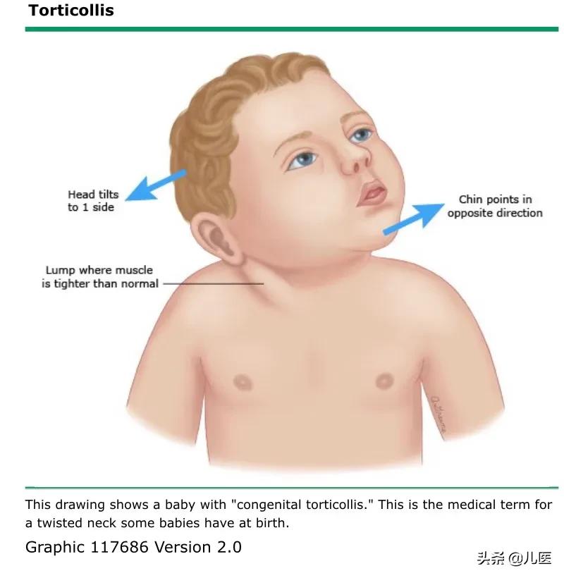 儿童斜颈康复训练活动,儿童斜颈基础教育篇