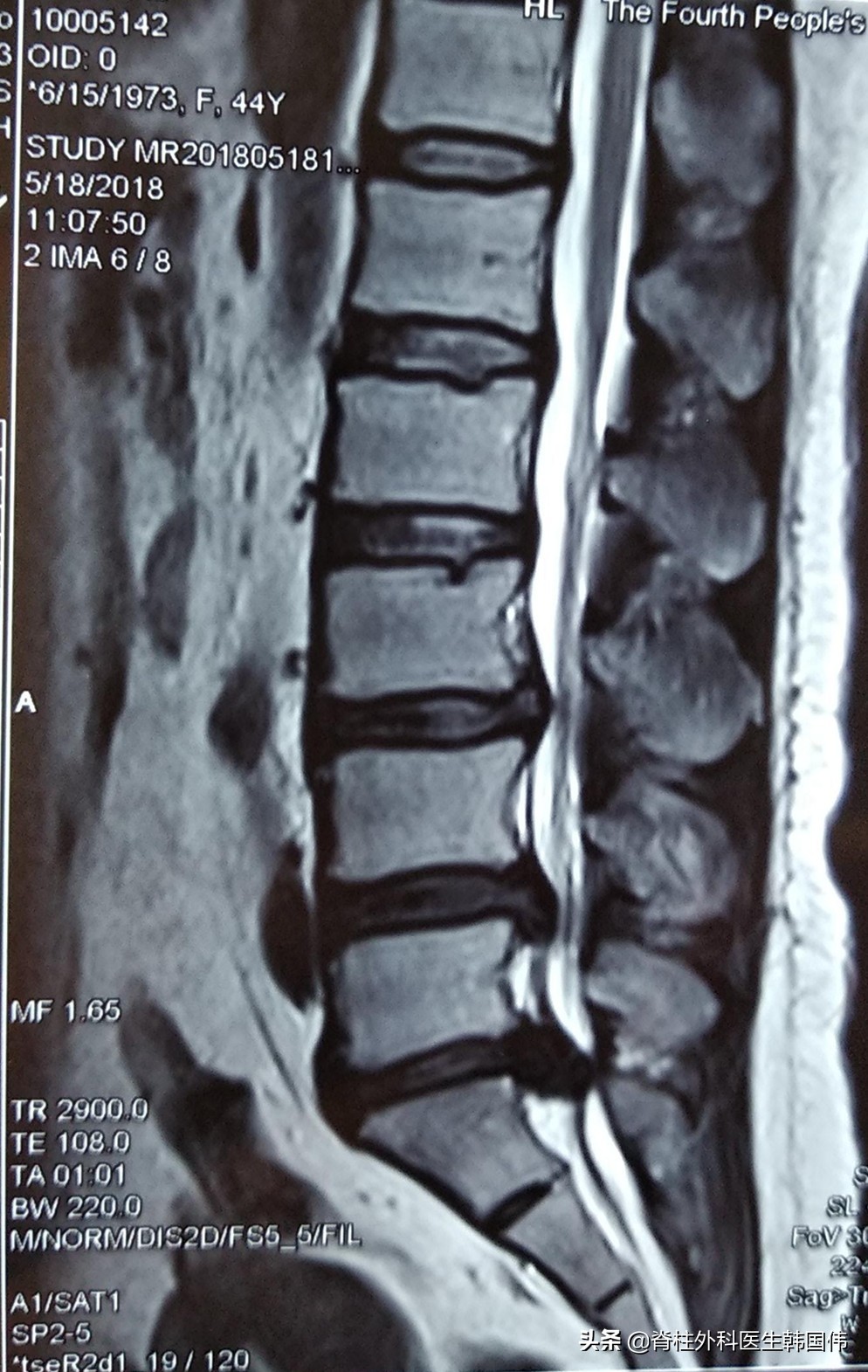 髓核脱出后微创手术后还麻木,腰椎髓核脱出压迫下肢神经严重吗