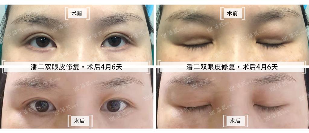 10年前做过韩式双眼皮,做过韩式三点双眼皮还能开眼角吗