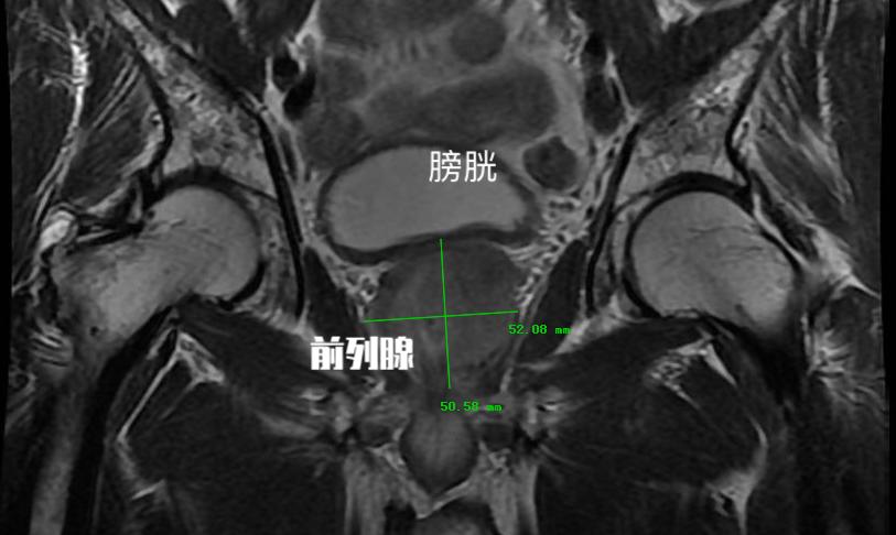 良性前列腺增生最早出现的症状是,彩超提示前列腺增生是前列腺癌吗