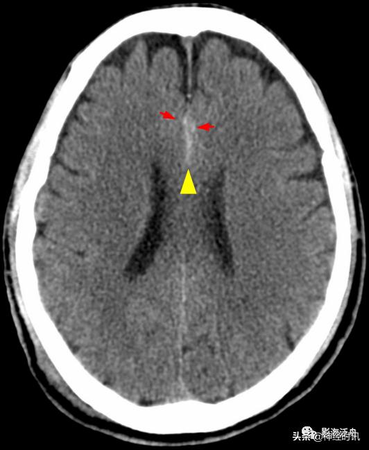 蛛血的临床表现,蛛血ct表现