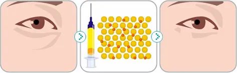 轻医美干细胞填充泪沟真实案例,泪沟明显怎么做医美