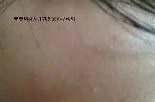 闭口粉刺痘痘黑头白头的区别,开口粉刺和闭口怎么区分