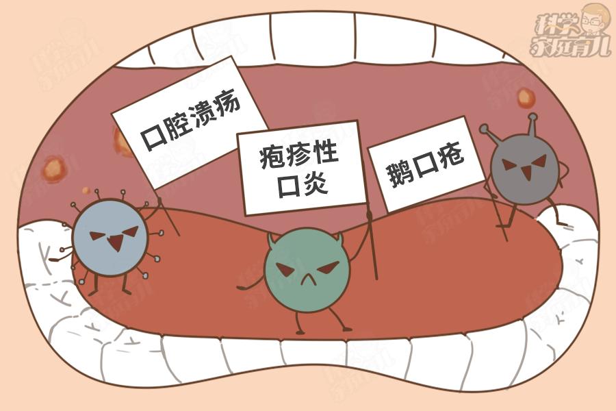 口腔溃疡要好的征兆,儿童经常口腔溃疡是癌症的前兆