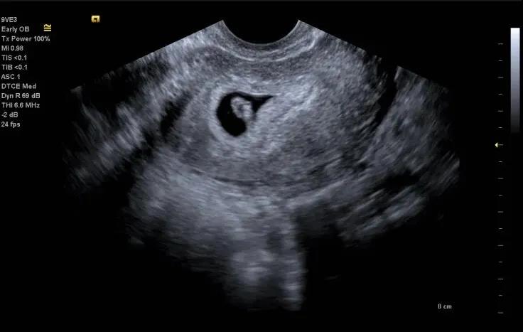 孕期检查做几次四维彩超,孕期产检需要做几次肝胆彩超