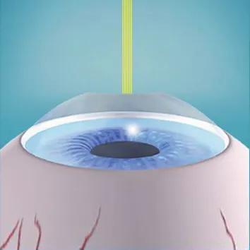 术前必须做的检查项目,近视手术的几种方式优缺点对比图