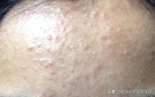 夏天皮肤病的预防,夏天常见皮肤病诊断及用药图谱