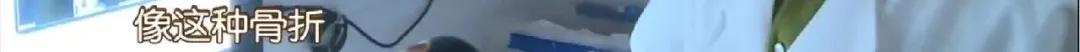 断骨手法复位视频,身怀绝技全集