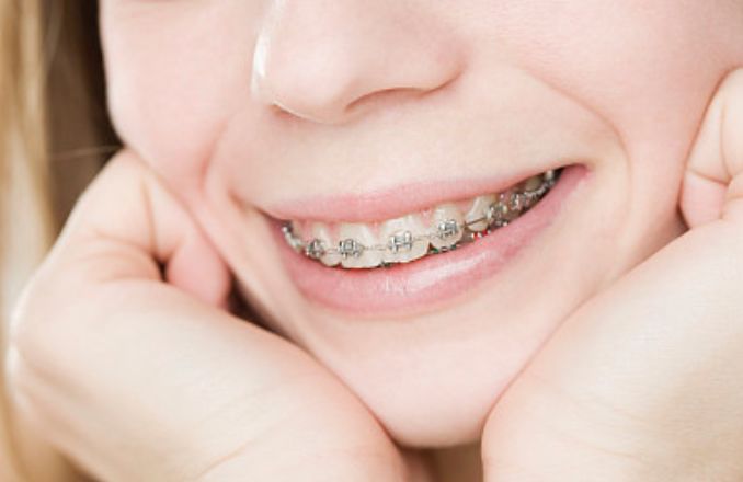 拔智齿多久之后可以戴牙套,拔智齿以后需要带什么