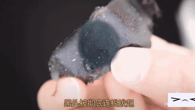 黑头闭口连根拔起,黑头粉刺连根拔起留坑