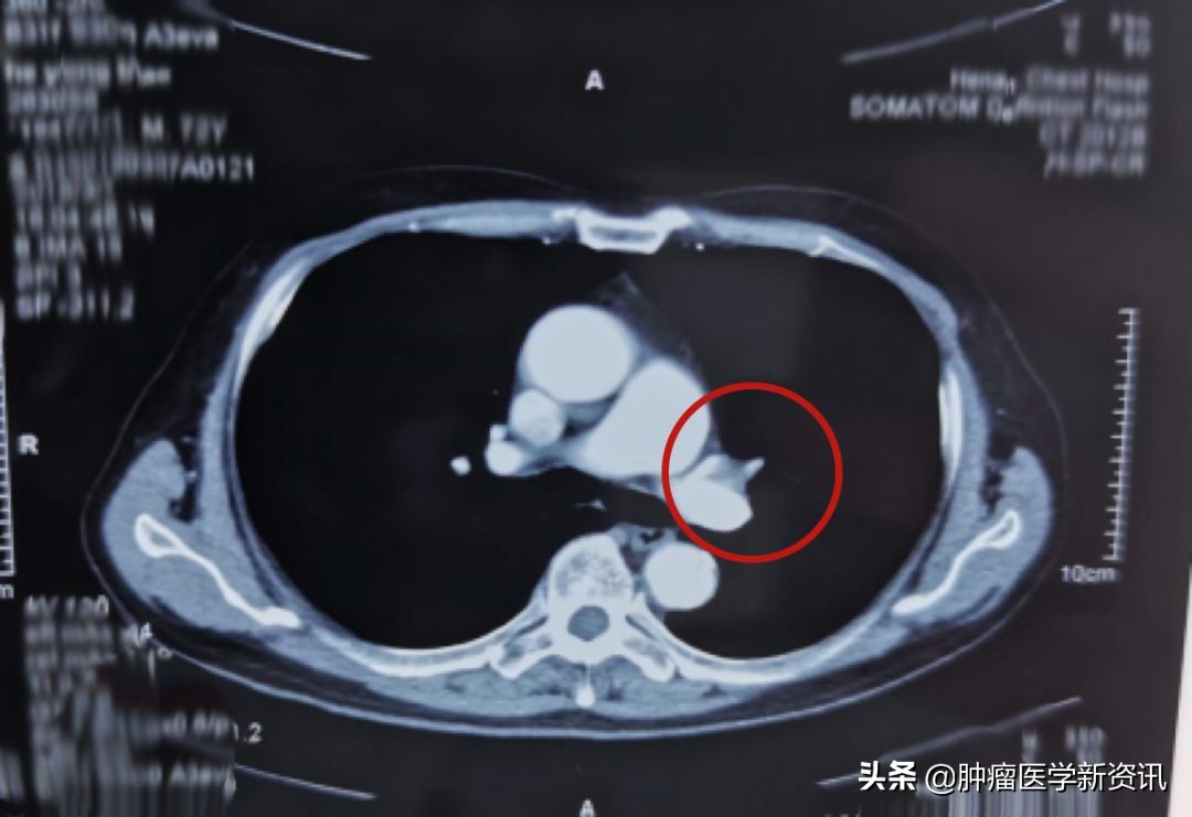 肺癌早期的6个信号中医治癌,肺癌正确的抗癌方法