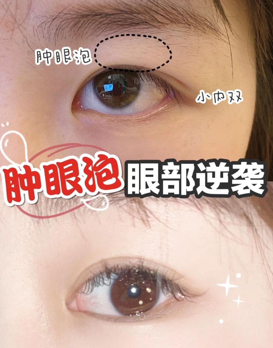 眼部消肿教程,眼部消肿最有效的方法