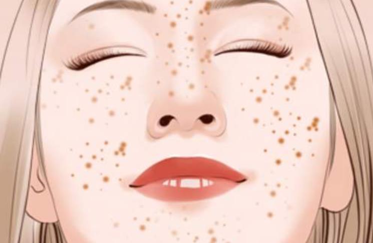 激光祛雀斑后每天变化图,激光祛雀斑反弹几率大吗