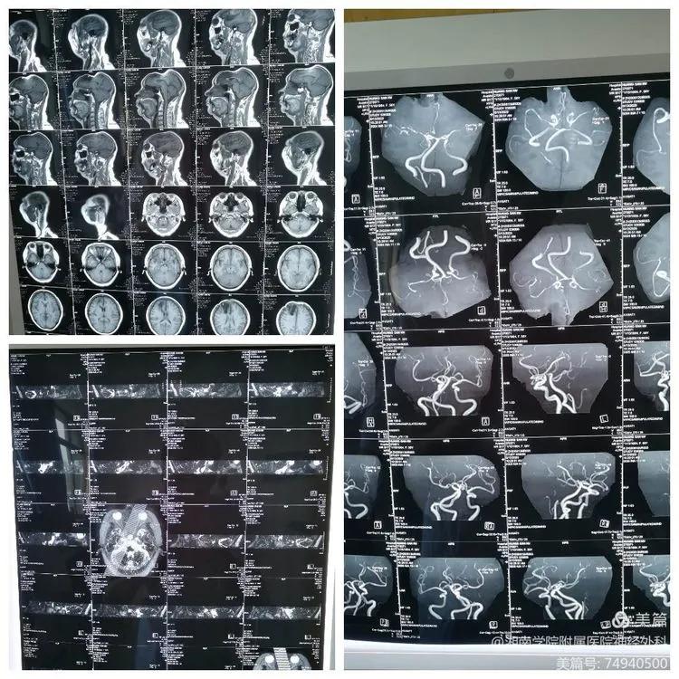 微血管减压术治疗面肌痉挛康复,面肌痉挛显微血管减压术一次解决