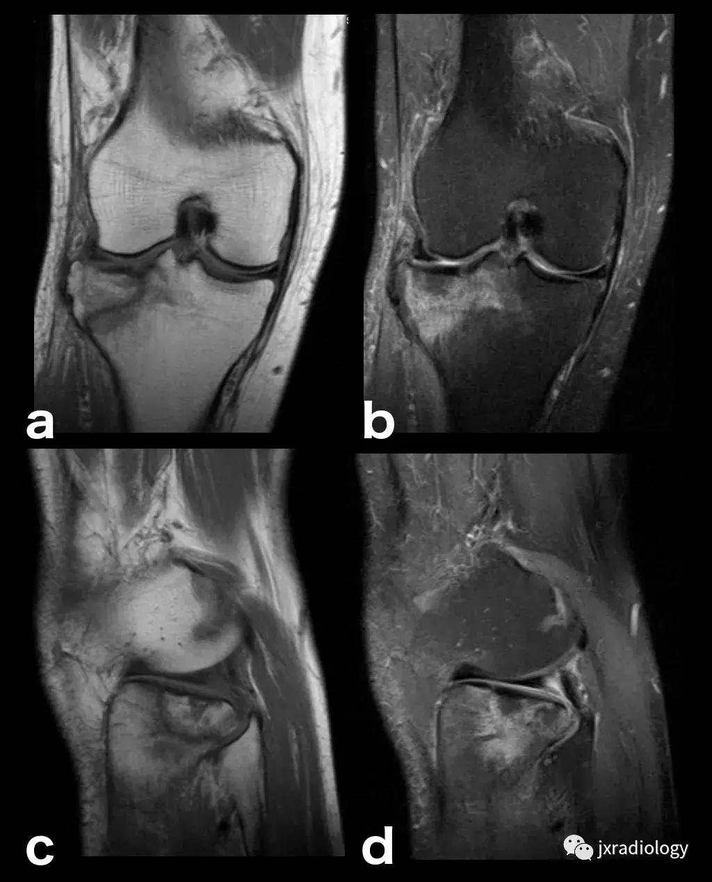 磁共振天天诊断骨髓水肿，但您知道原因吗？