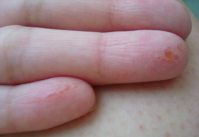 手脚出现水泡还发痒,天热手脚起水泡是怎么回事