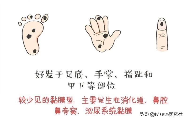 眼下有痣胸上也必定有痣吗,左胸有痣在上右胸有痣在下