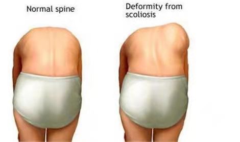 怎么矫正高低肩长短腿,脊柱侧弯高低肩瑜伽体式纠正