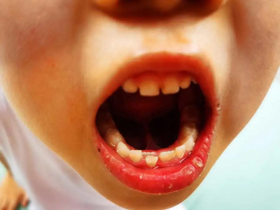 姚晨自曝儿子换牙问题,很多孩子中招!牙齿健康,家长们都要注意