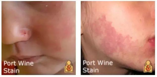 为什么宝宝出生屁股会有青胎记,宝宝出生屁股上有淤青是什么原因