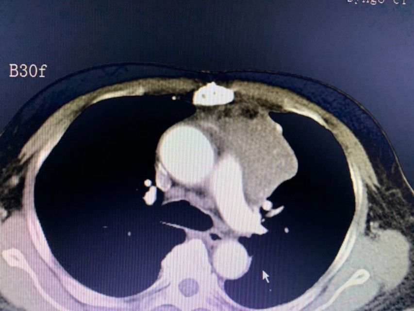 胸腺肿瘤不能手术该怎么治疗,胸腺瘤微波消融