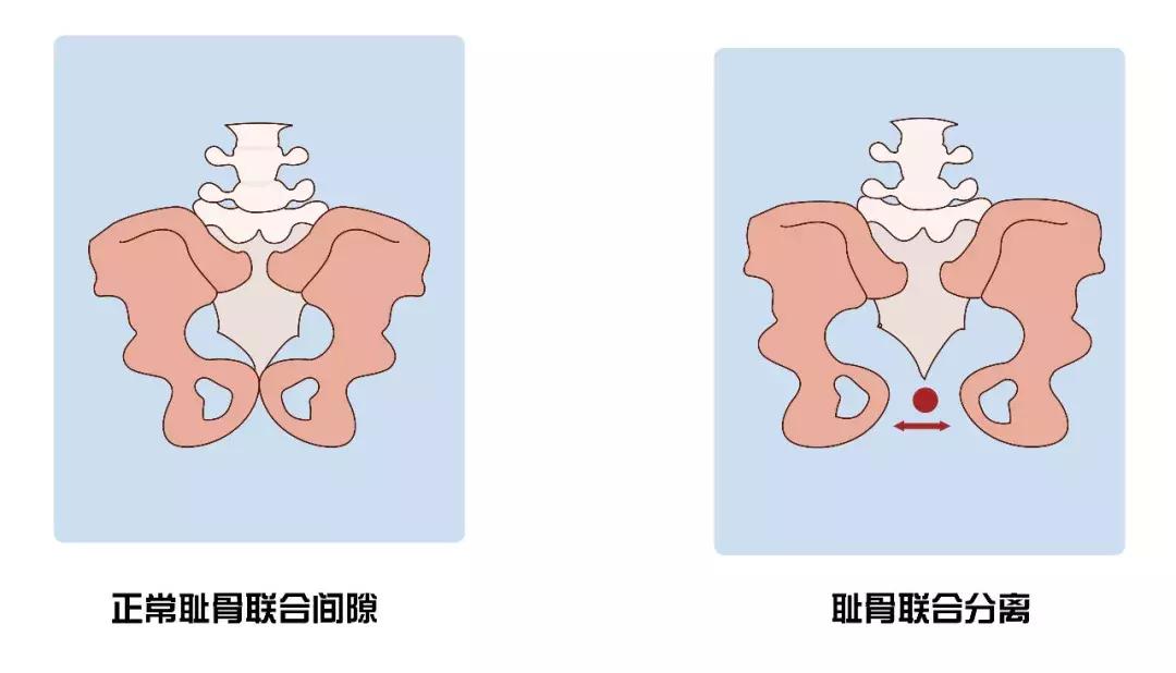 为什么2胎耻骨分离耻骨还特别痛,耻骨疼耻骨分离是要快生了吗