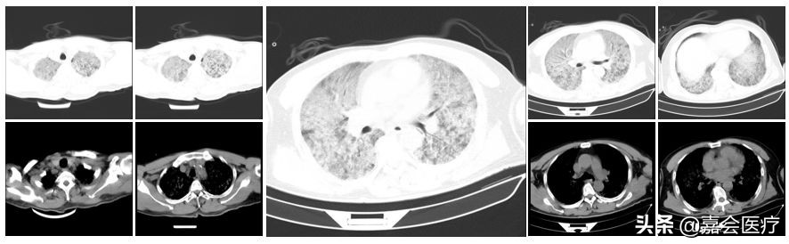 低烧大腿根烧痛是怎么回事,发热腿疼是什么原因