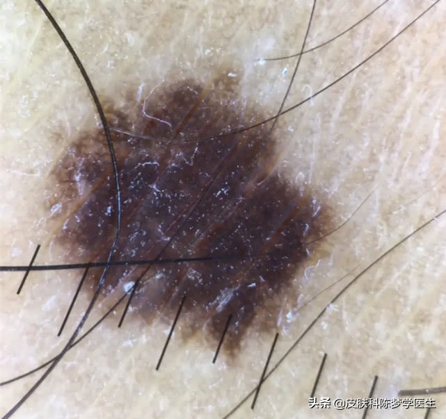 脸上长的痣如果癌变会怎样,最近身上脸上长了很多痣怎么回事