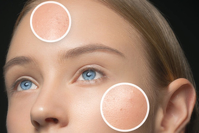 黑色痘印怎么能彻底消除,黑色痘印怎么消除小妙招视频