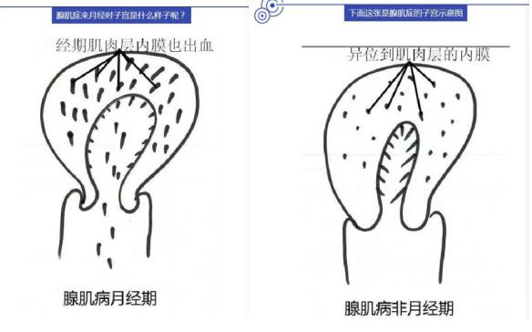 中医辨证子宫腺肌症,中医根治子宫腺肌症医案