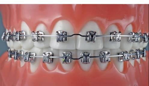 陶瓷还能用来做矫正？怎么做到的？