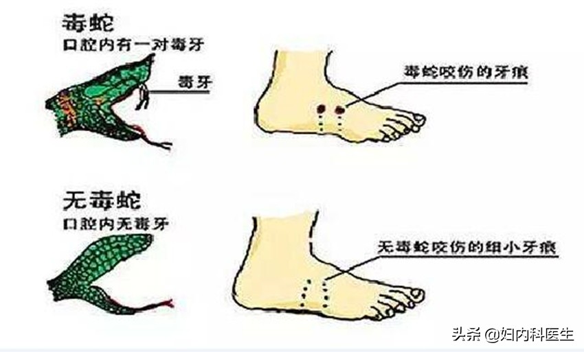 网友被毒蛇咬伤自救,被毒蛇咬伤如何自救原视频