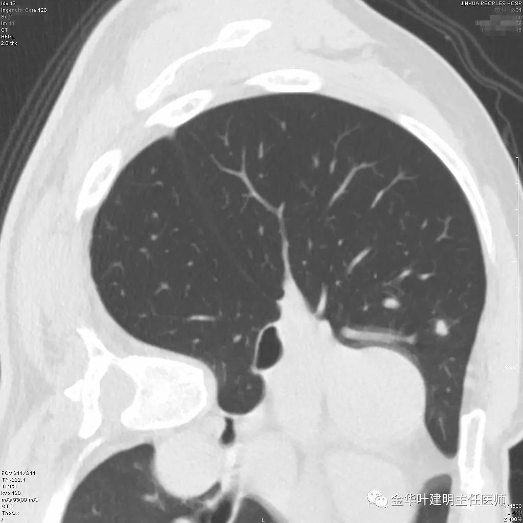叶建明谈肺结节:一招分辨隐球菌性肉芽肿与肺癌