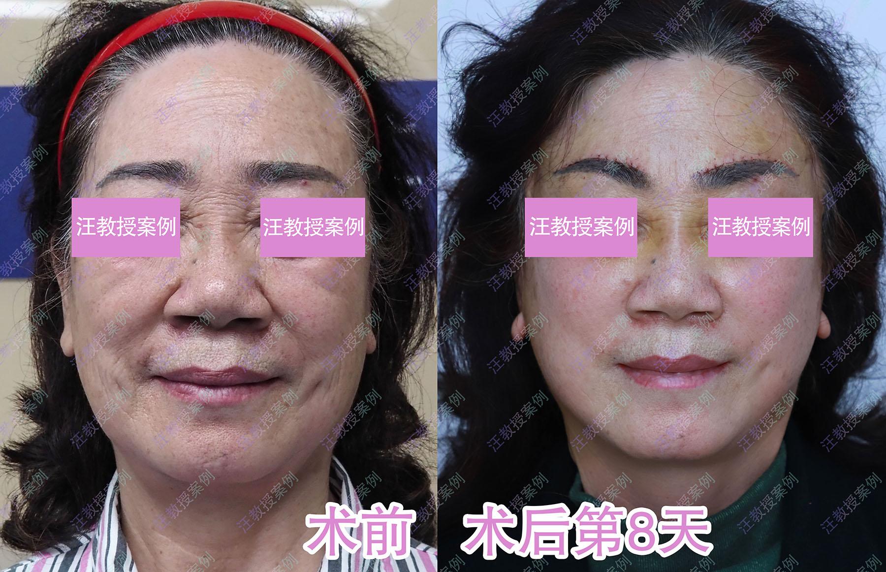 中医治眼袋大泪沟深自己怎么调理,二个方法解决眼袋泪沟七天有效