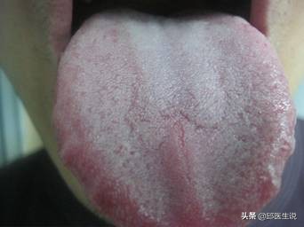 湿热寒湿痰湿并存怎么调理,寒湿型湿气