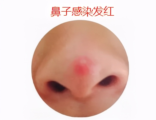 假体鼻整形手术全过程,鼻整形不满意多久可以取出假体