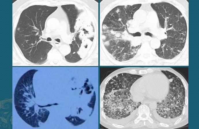 肺诺卡菌感染，当1种分解落叶的细菌，被吸入肺脏