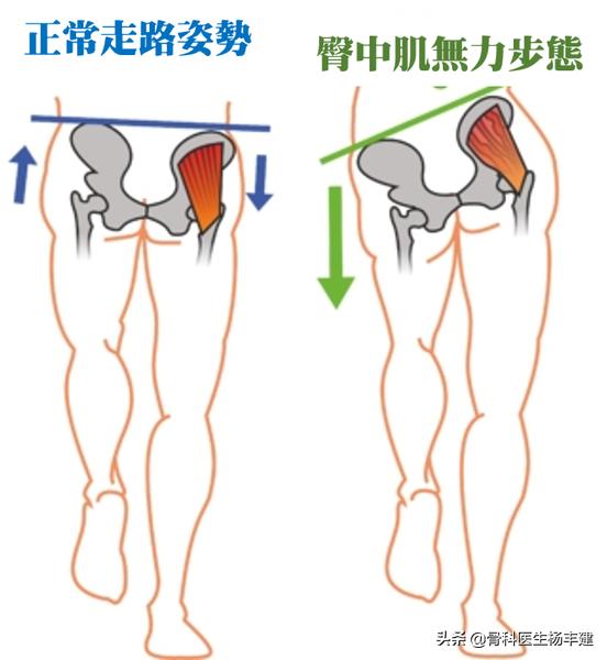 老年人常见的髋部损伤有哪些,跑步的常见损伤之髋关节