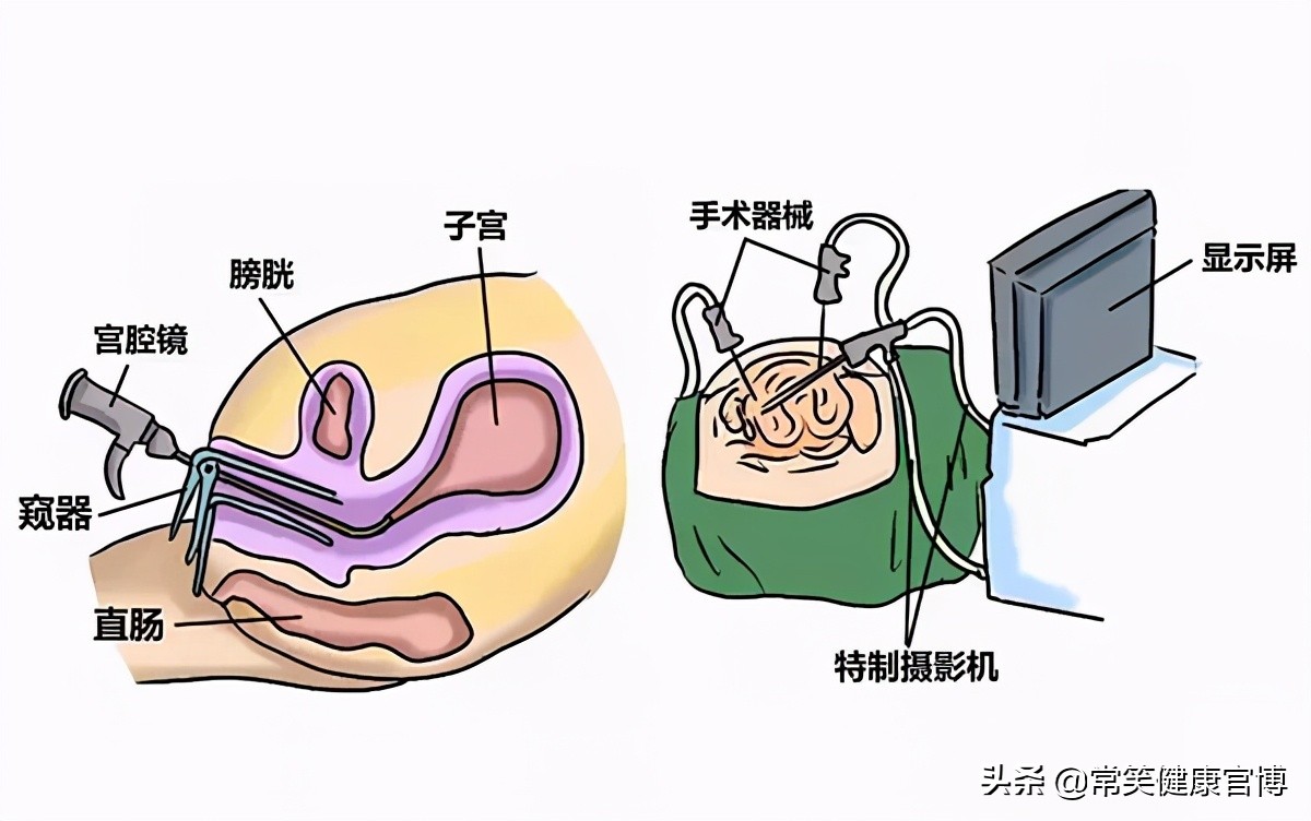 纵隔子宫是怎么回事,纵隔子宫修复