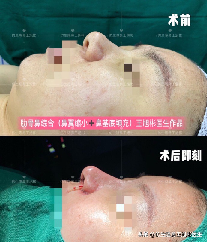 鼻头肥大矫正加鼻翼缩窄案例,鼻头缩小术后