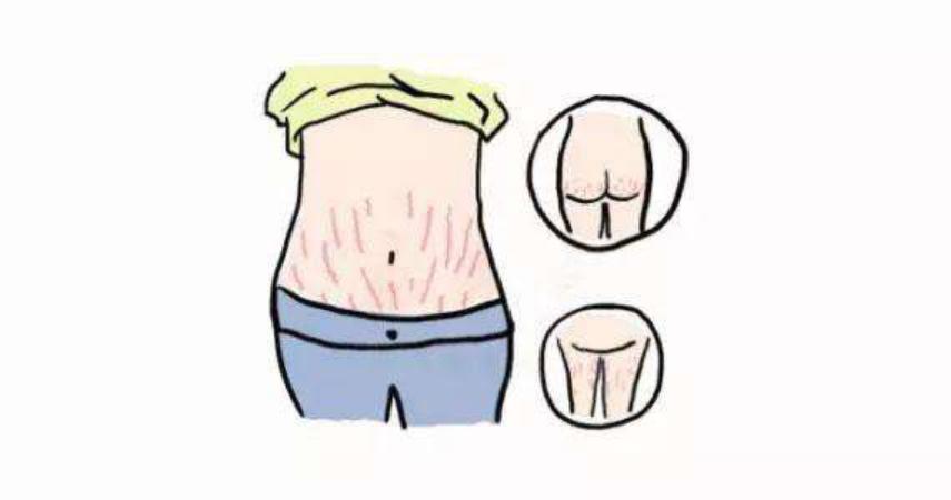 怀孕七个月肚子痒还要长妊娠纹吗,孕妇长妊娠纹的地方痒的受不了