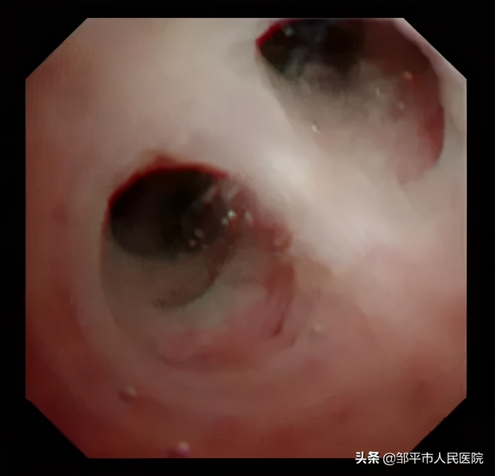 重症肺炎最佳治疗方法,满月宝宝重症肺炎如何治疗