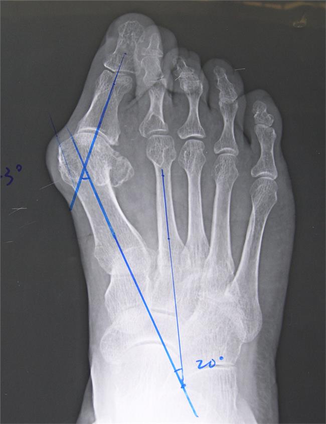 拇外翻克星,拇趾外翻畸形