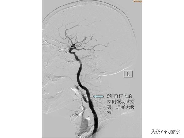 颈动脉狭窄介入治疗,颈动脉狭窄介入手术多少钱