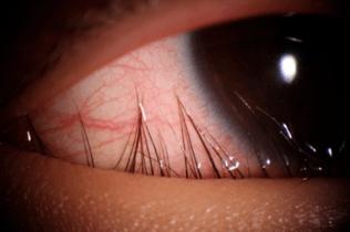 眼睑内翻倒睫治疗方法,老年人倒睫最快的治疗方法