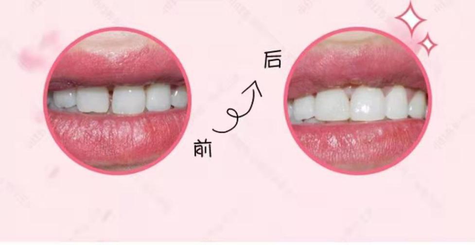 牙缝变大咬东西酸软无力,牙缝变大不舒服