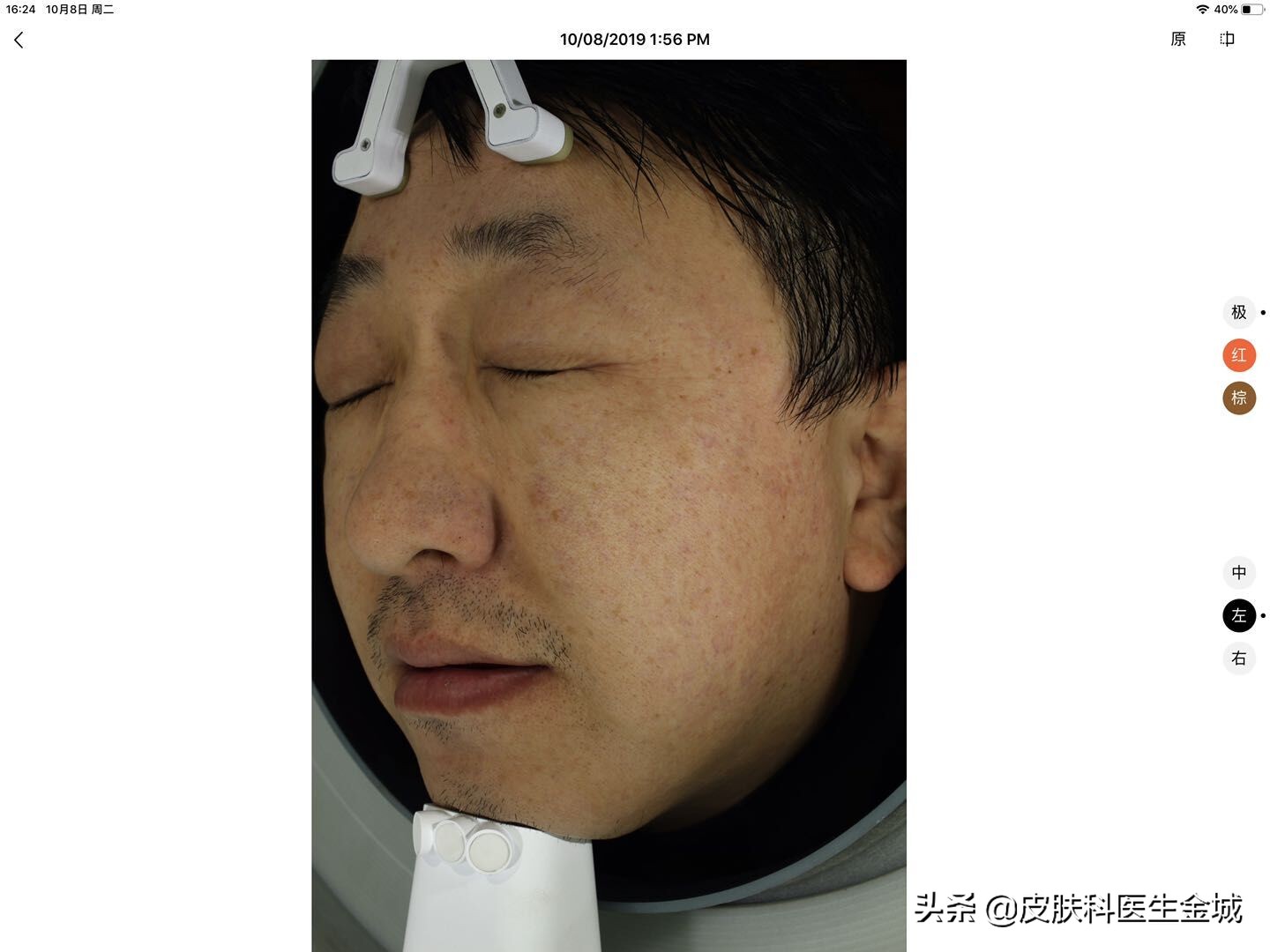 皮肤美容医生超皮秒全体验,皮肤美容医生超皮秒