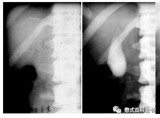 开展mrcp技术,mrcp检查操作流程